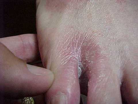 Athlete's foot. To combat it there is a Candida diet